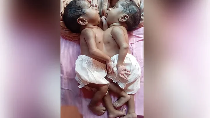 জোড়া লাগা যমজ শিশু দুটি মারা গেছে